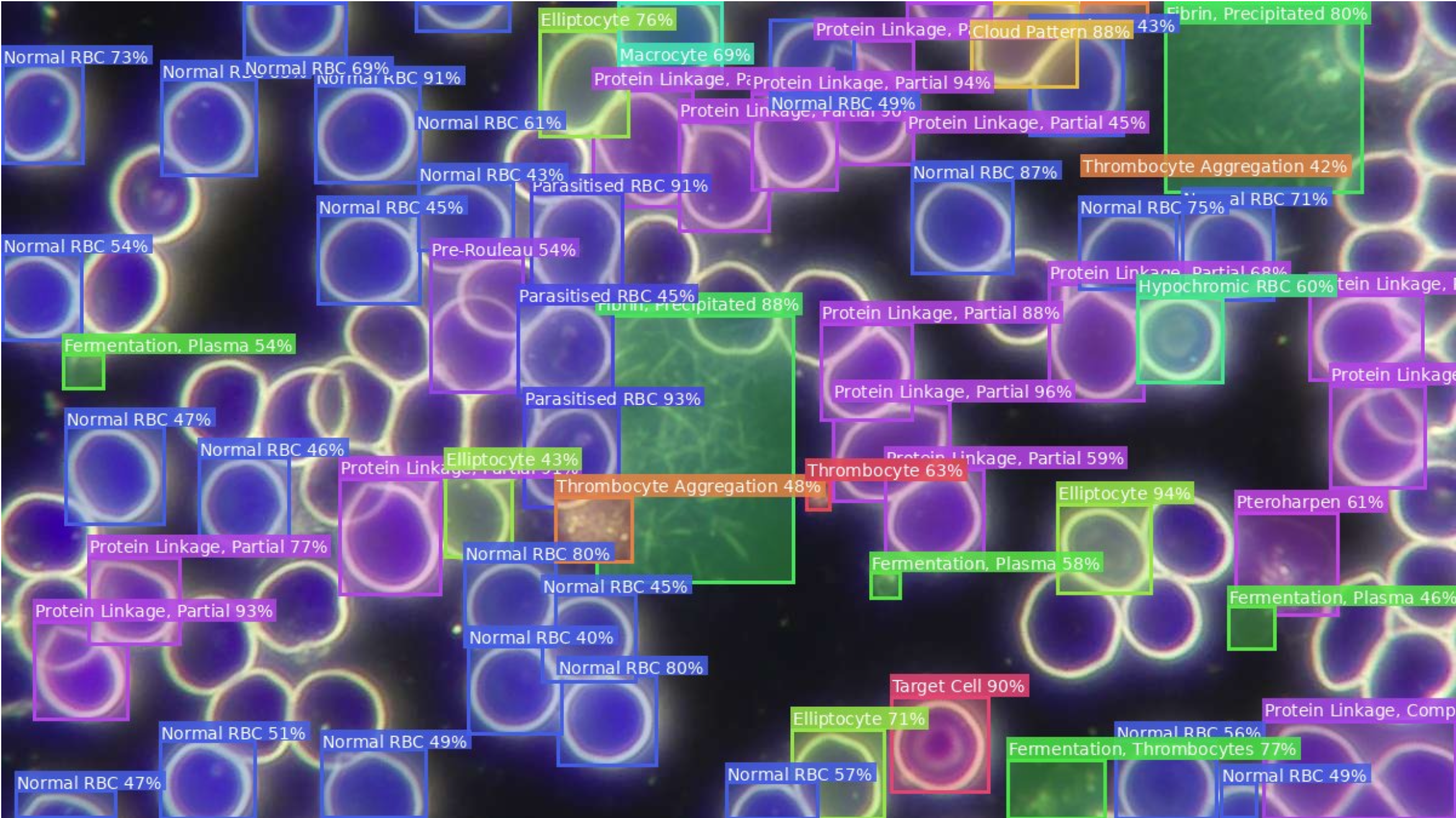 Same darkfield image annotated by BloodWorX AI with labelled bounding boxes identifying ghost cells, neutrophils, schistocytes and other anomalies